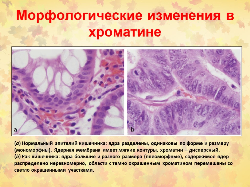 Морфологические изменения в хроматине (a) Нормальный эпителий кишечника: ядра разделены, одинаковы по форме и